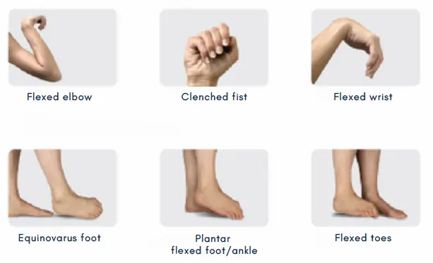 Adult Limb Spasticity
